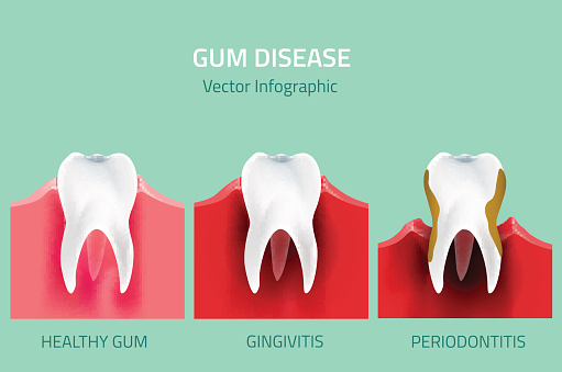 Diagram of the various stages of periodontal disease, which can be treated at Martin Periodontics in Mason & North Cincinnati, OH