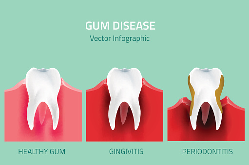 Gingivitist treatment at Martin Periodontics 