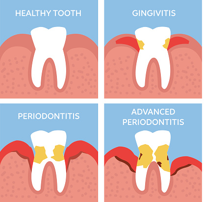 Cross-section of a tooth in the gums during the stages of periodontal disease