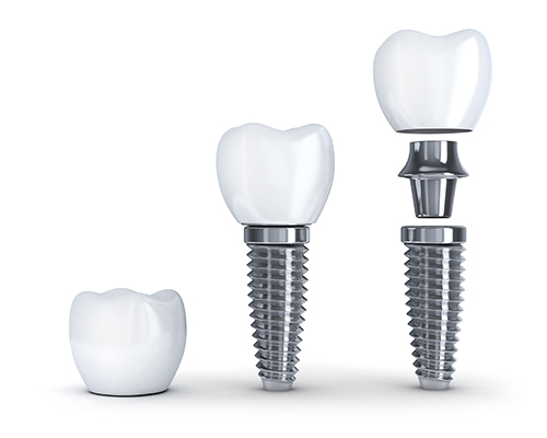 Dental implants at Martin Periodontics in Mason, OH