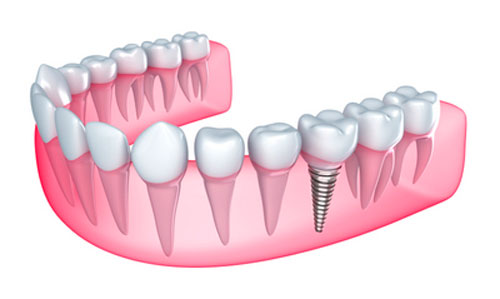 Image of a dental implant model, at Martin Periodontics in Mason, OH. 