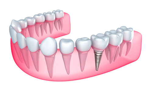 What Are Peri-Implant Diseases?