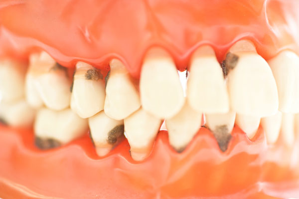 Photo of gum recession