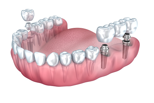 tooth implant types