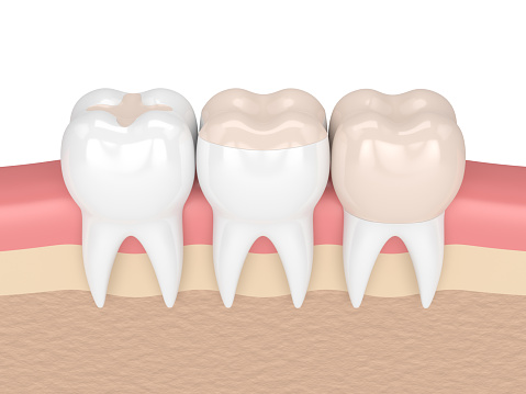 An example of composite fillings at Martin Periodontics in Mason, OH