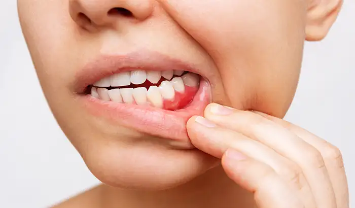 Woman showing her gums