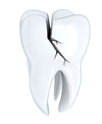 Understanding an Uncomplicated Crown Fracture