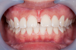 Close-up of healthy teeth with a gap at Martin Periodontics
