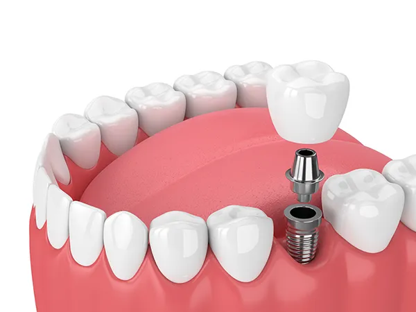 Photo of dental implant at Martin Periodontics in Mason, OH