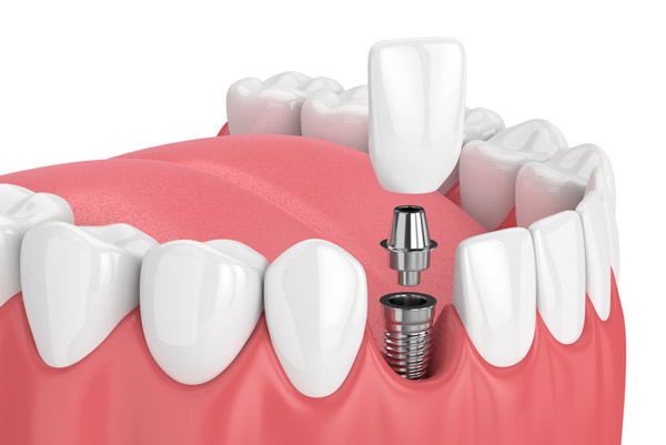 Photo of dental implants from Martin Periodontics in Mason, OH