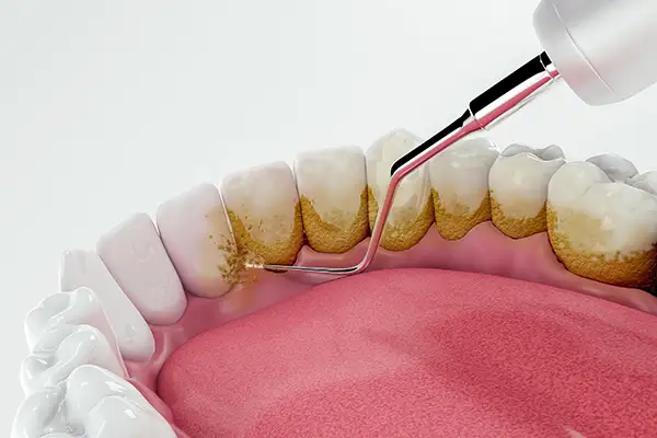 a 3d rendering of teeth undergoing periodontal treatment