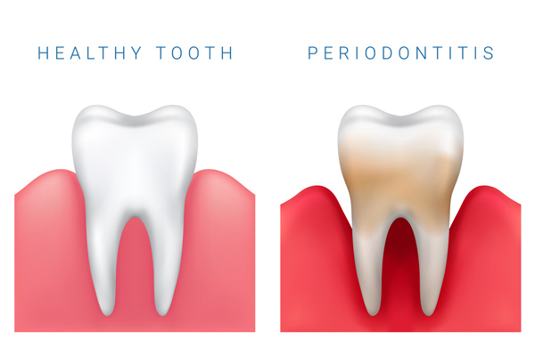 Photo of healthy and gum disease tooth at Martin Periodontics in Mason, OH