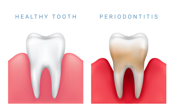 Surgical and Non-surgical Trends in Periodontal Treatment