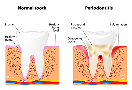 Dental Consequences of Periodontal Disease chart from Martin Periodontics in Mason & North Cincinnati, OH