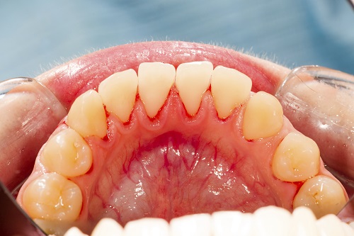 Image of a person's lower teeth and gum tissue, at Martin Periodontics in Mason, OH.