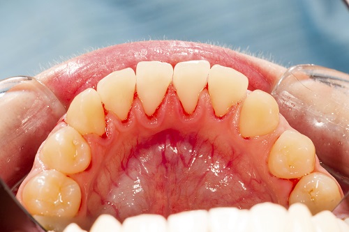 All You Need to Know About Periodontal Disease