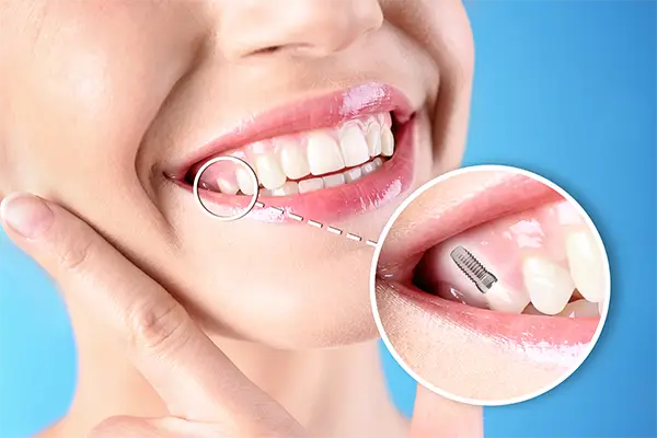 Smiling woman pointing to her teeth with an inset showing an x-ray view of a dental implant set in the jaw.