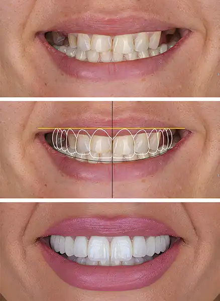 Three smiles in row: the first shows a smile with missing teeth and stained enamel, the second shows a smile design outline overlaying the first smile, and the third shows the final result: a beautiful, clean, bright smile.